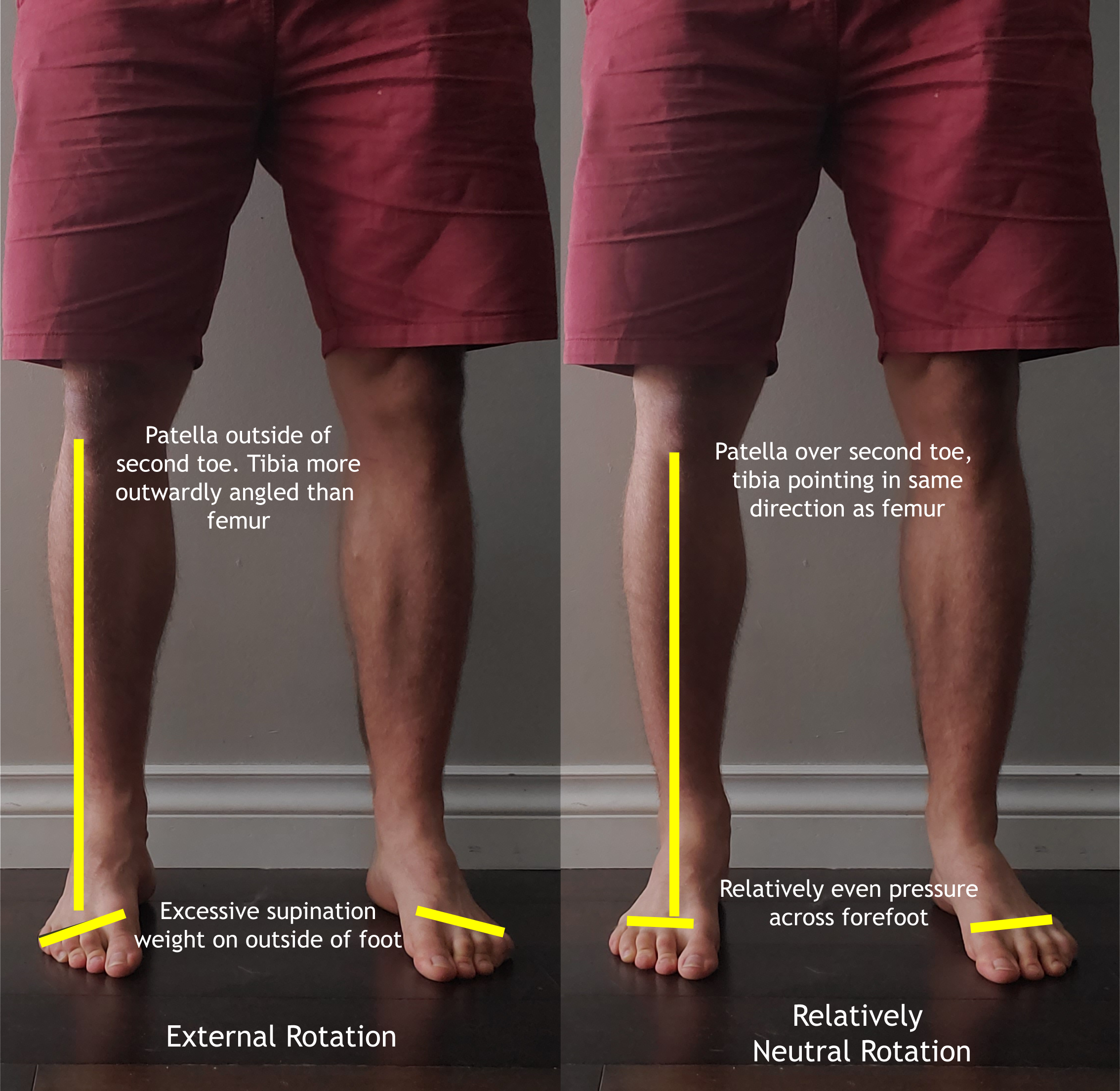 tibial internal rotation